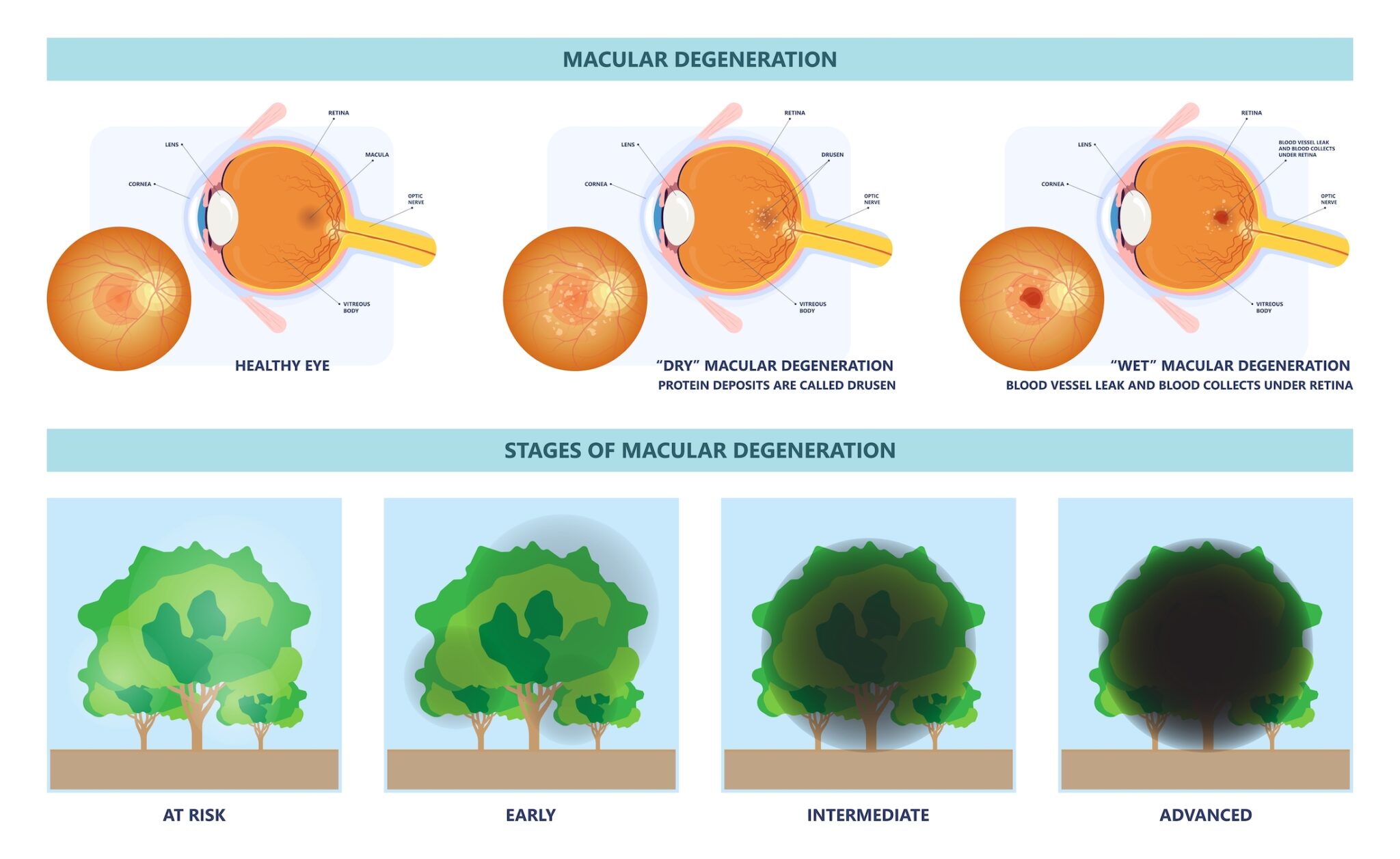 Macular Degeneration Alaska Retinal Consultants